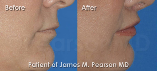 Los Angeles Lip Lift Photos