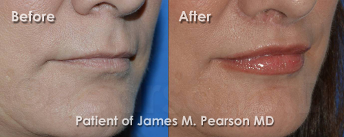 Pearson Lip Enhancement