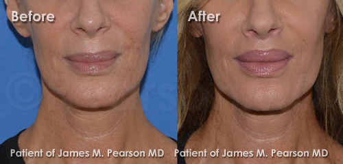Photo Beverly Hills Lip Lift by Dr. James Pearson Facial Plastic Surgery Pearson Lip Lift Photos