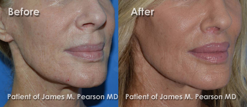 Photo Lip Lift by Dr. James Pearson Facial Plastic Surgery Pearson Lip Lift Photos