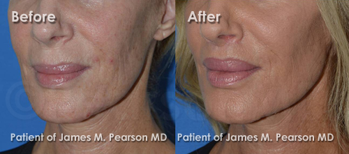 Photo Los Angeles Lip Lift by Dr. James Pearson Facial Plastic Surgery Pearson Lip Lift Photos