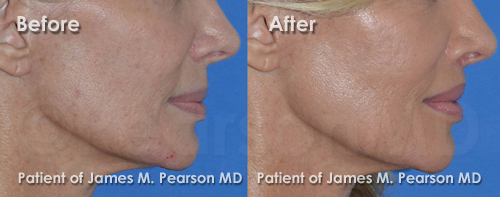 Photo Lip Lift by Dr. James Pearson Facial Plastic Surgery Pearson Lip Lift Photos
