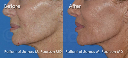 Photo Natural Lip Lift by Dr. James Pearson Facial Plastic Surgery Pearson Lip Lift Photos