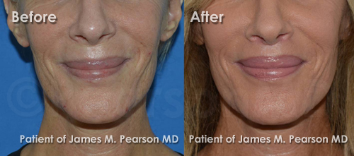 Photo Undetectable Lip Lift by Dr. James Pearson Facial Plastic Surgery Pearson Lip Lift Photos
