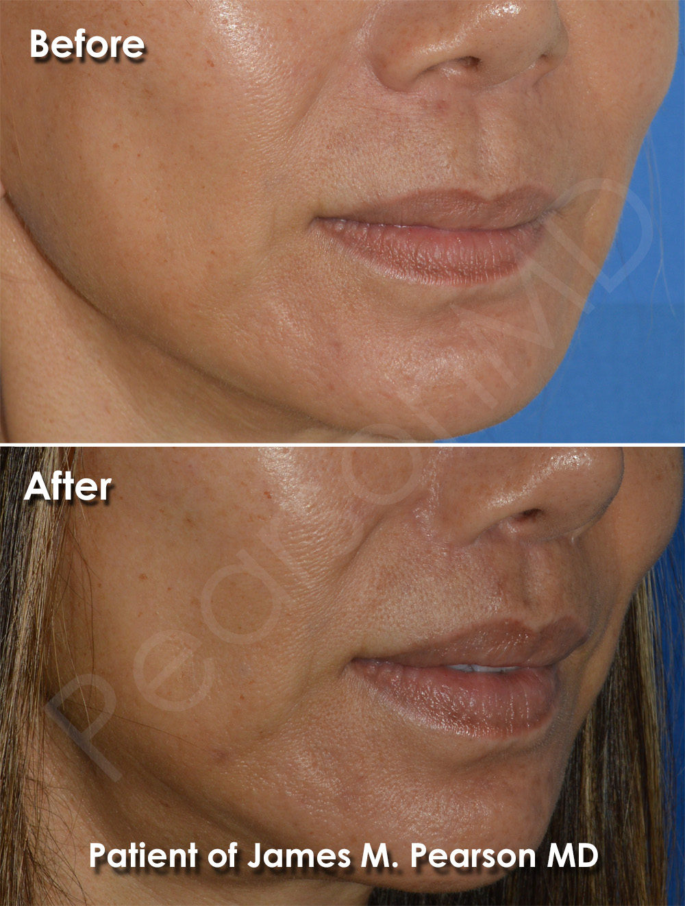 Dr. Pearson Lip Plastic Surgery
