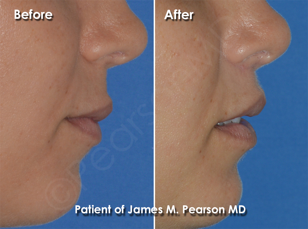 Pearson Lip Plastic Surgery