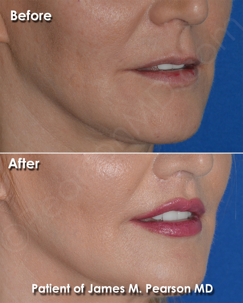 Lip Lift Beverly Hills