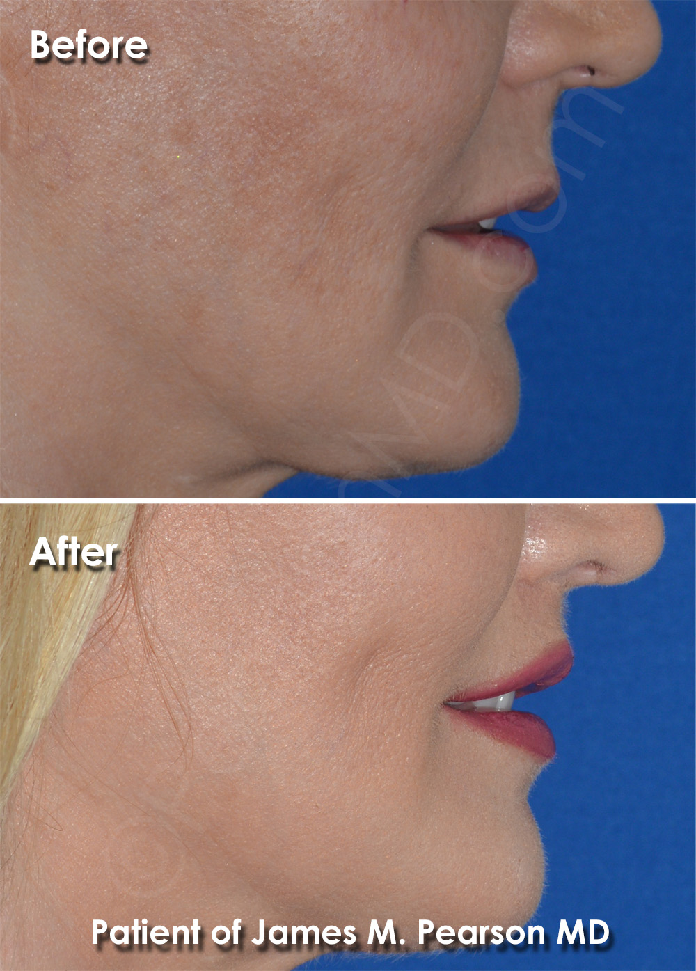 Lip Lift Specialist