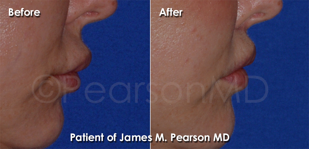 Pearson Plastic Surgery