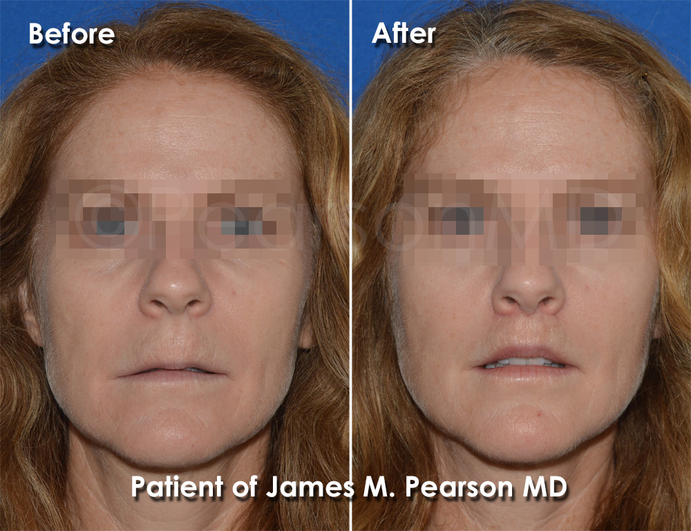 Lip Lift Specialist