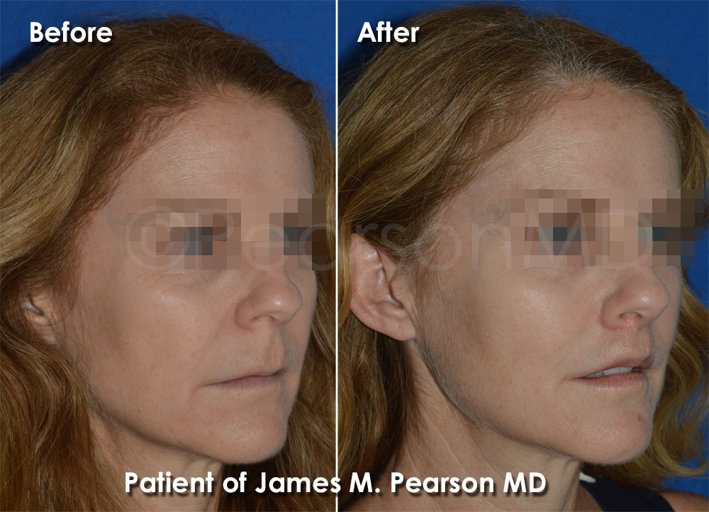 Beverly Hills Lip Lift