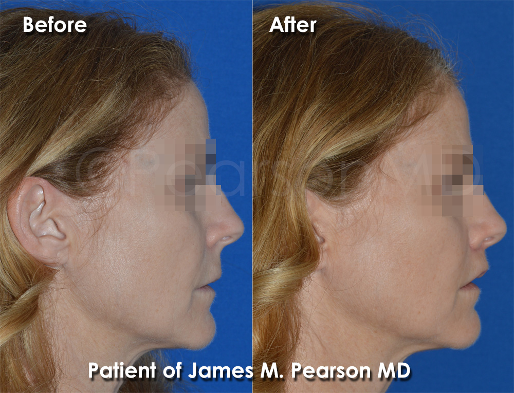 Expert Lip Lift