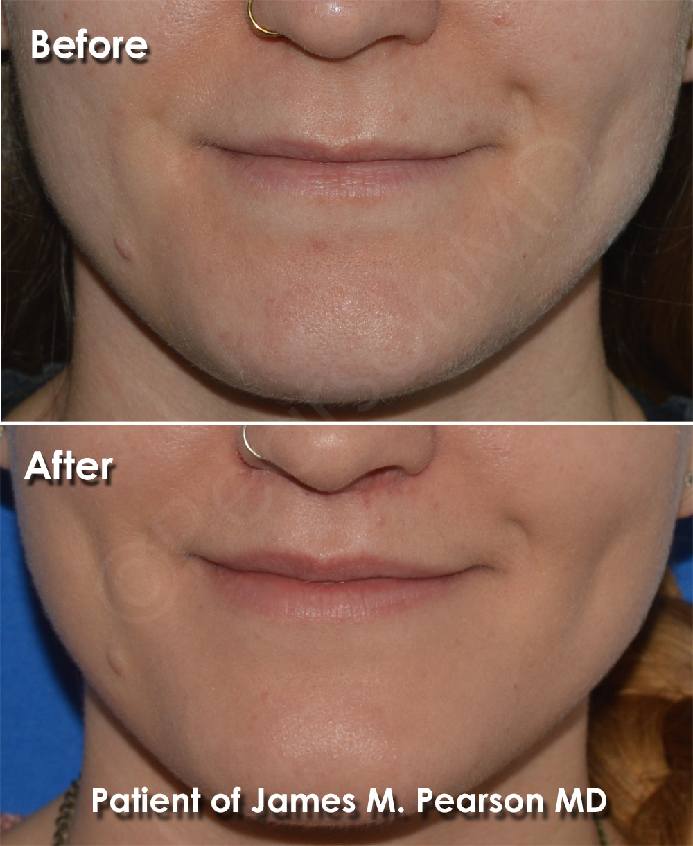 Dr. Pearson Plastic Surgeon