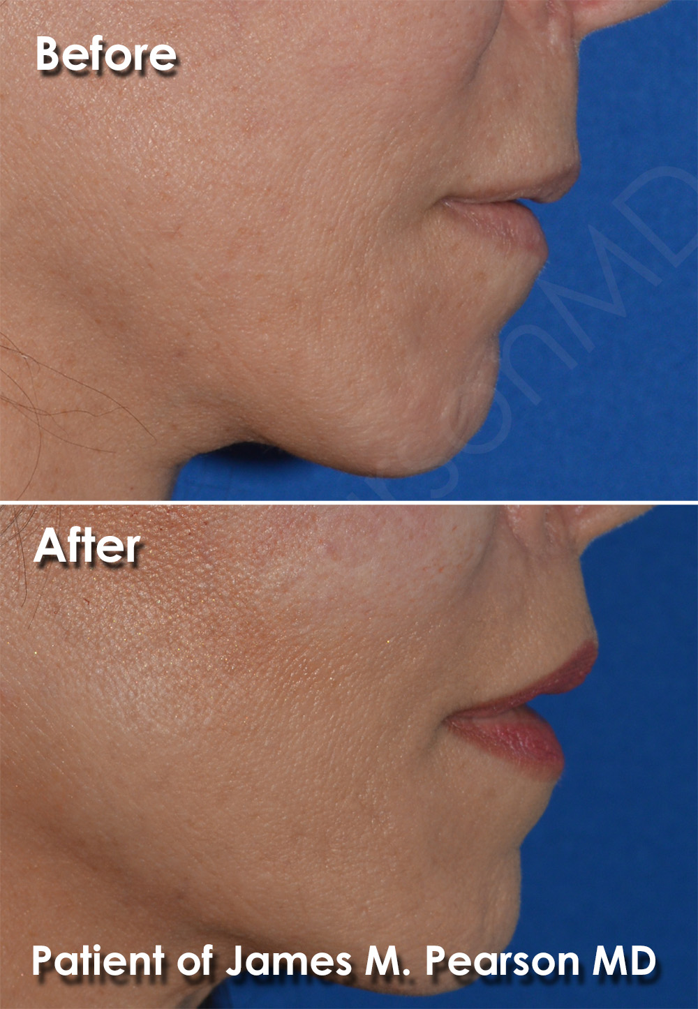 Pearson Plastic Surgery