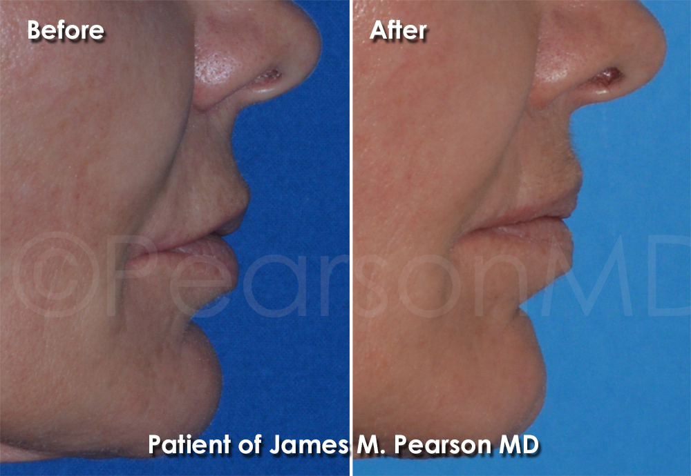 Lip Lift Expert