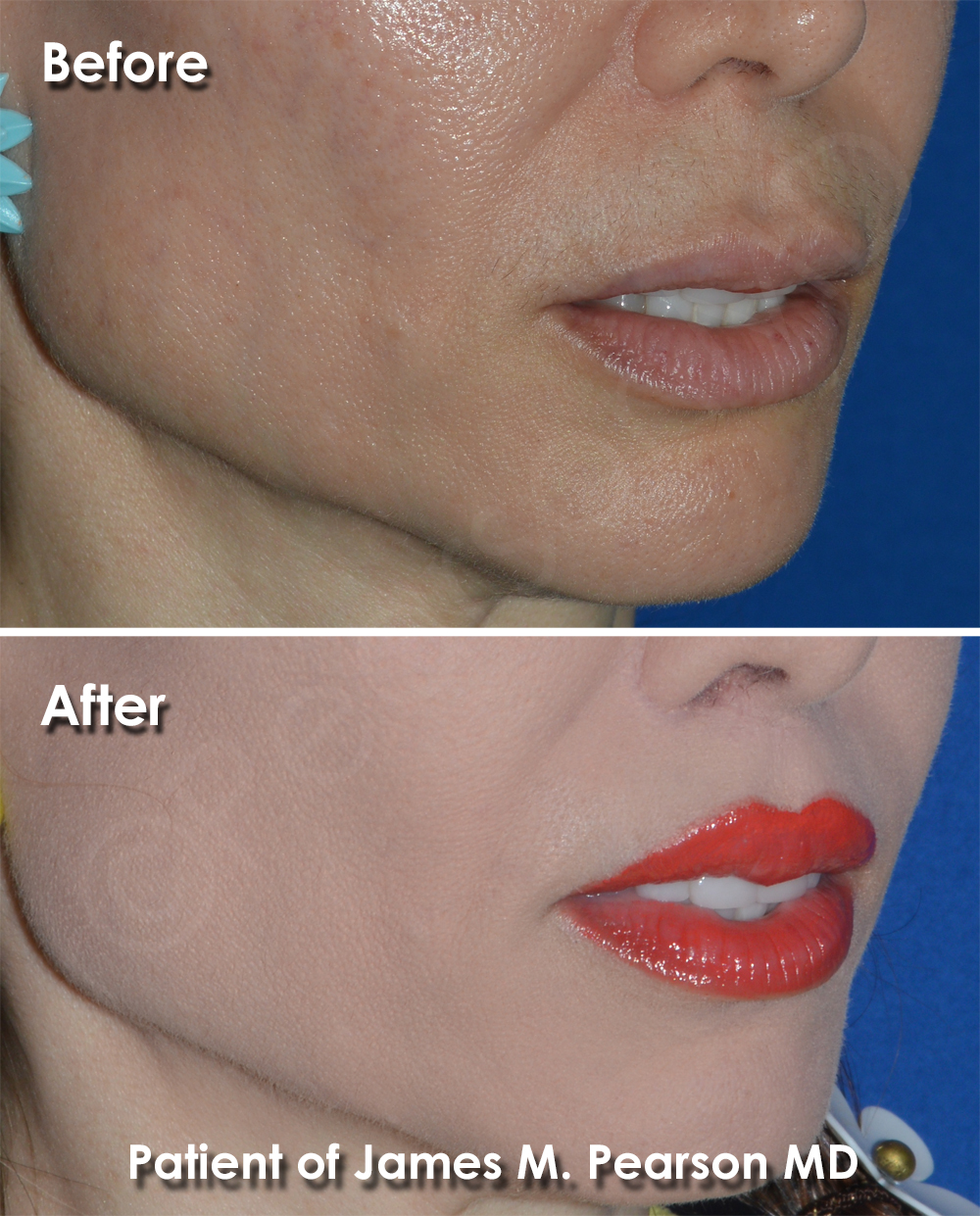 Pearson Plastic Surgeon