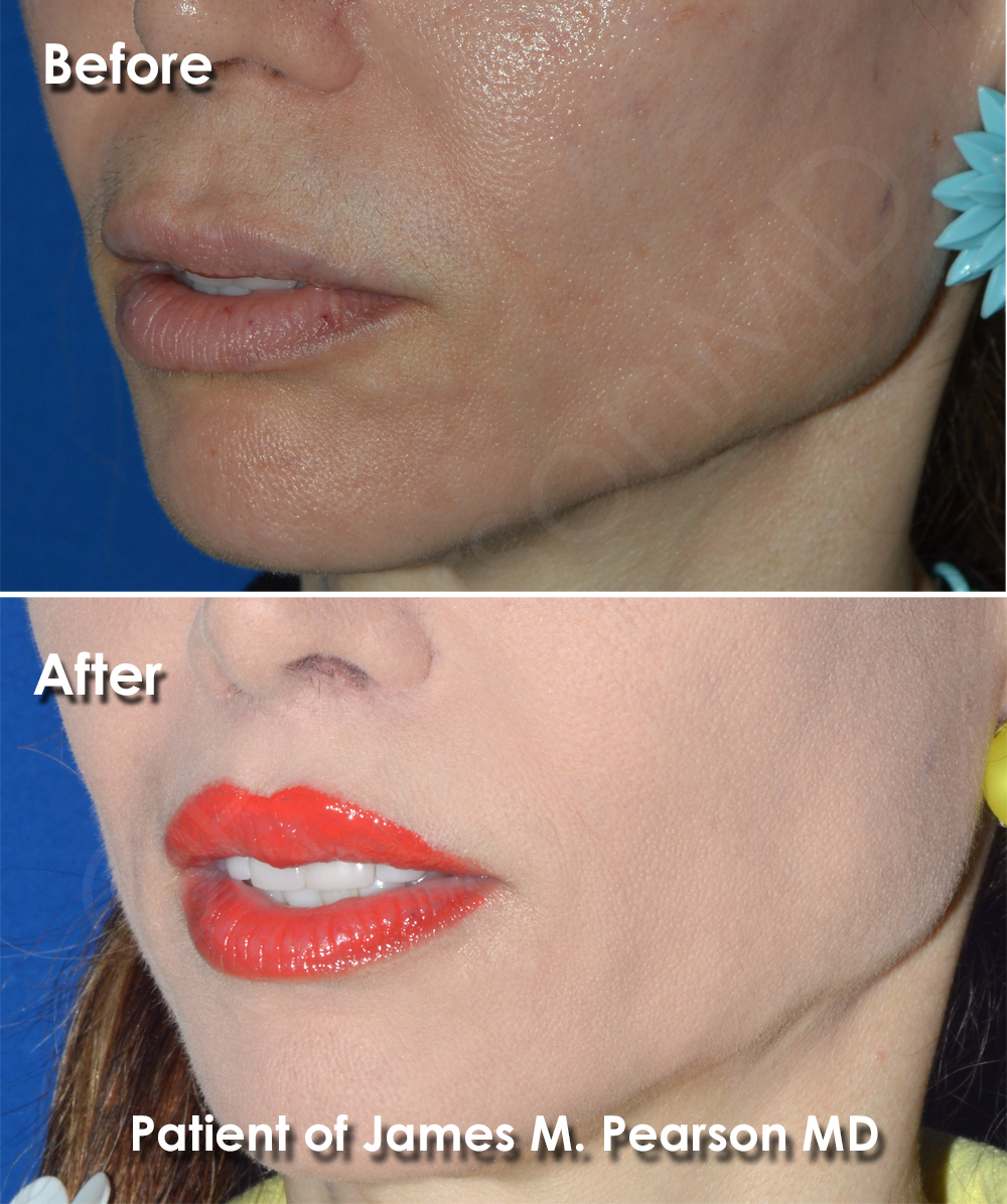 Dr. Pearson Plastic Surgeon