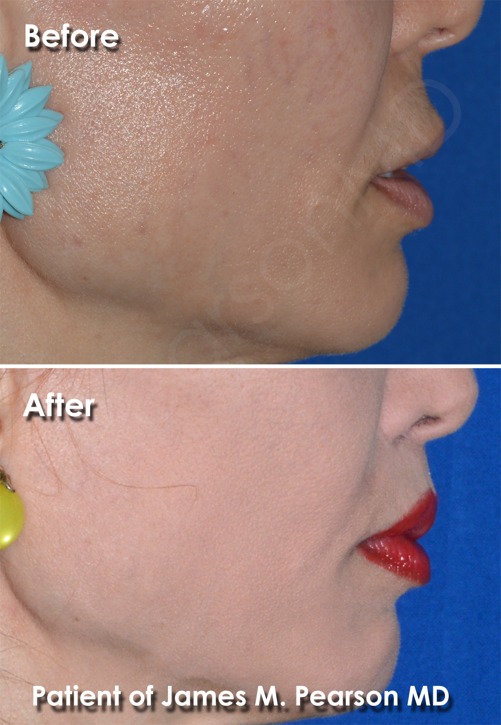 Pearson Plastic Surgery