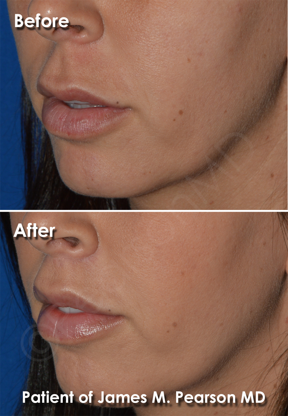Pearson Lip Plastic Surgery