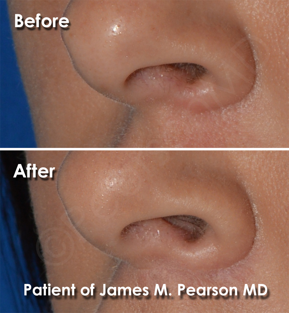 Lip Lift Scar