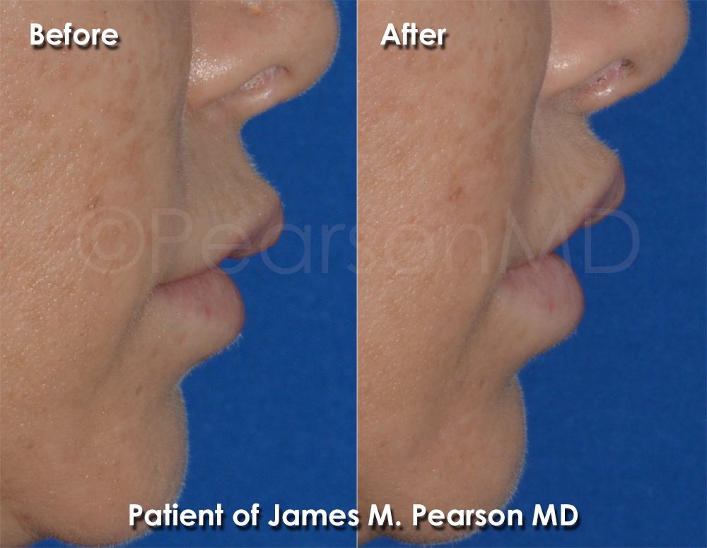 Pearson Plastic Surgery