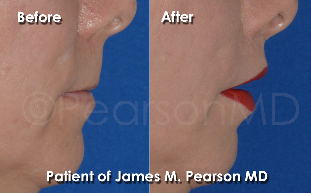 Lip Lift Expert