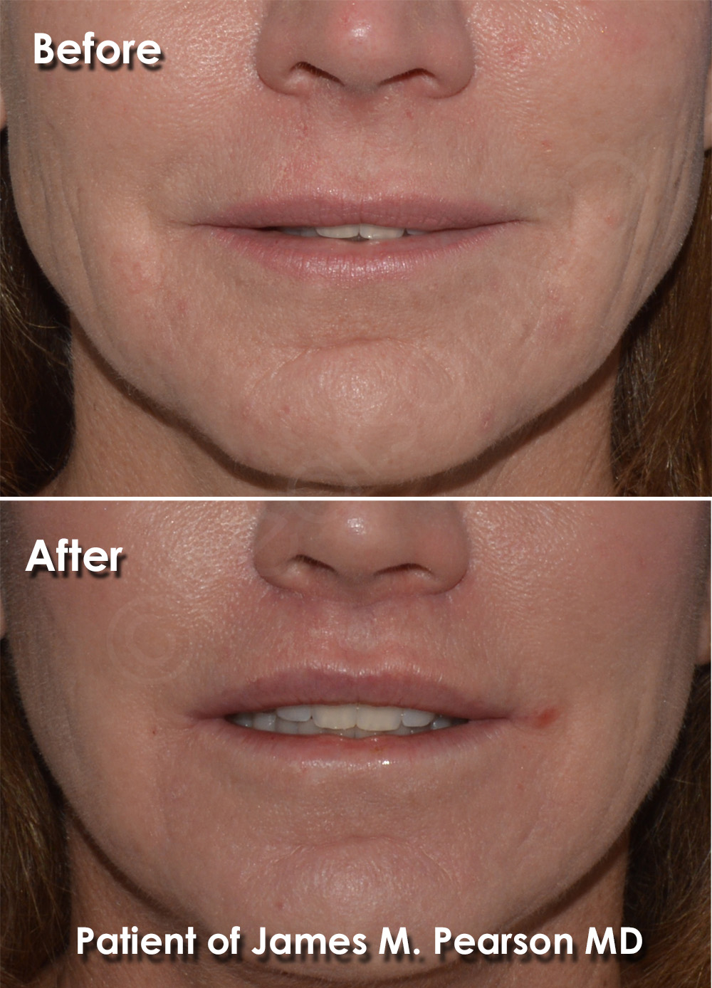 Pearson Lip Plastic Surgery