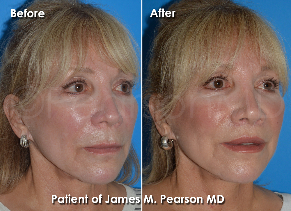Hermosa Beach Plastic Surgery