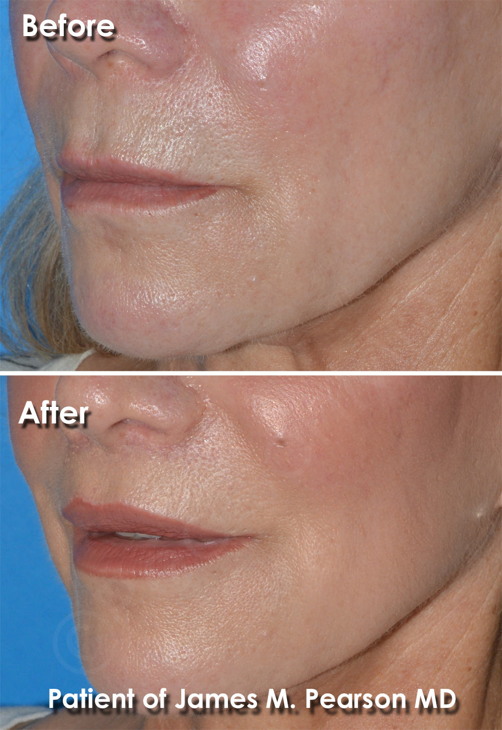 Lip Lift Expert