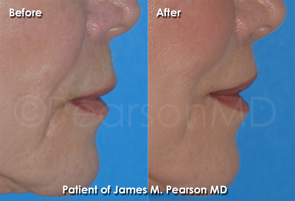 Redondo Beach Plastic Surgery