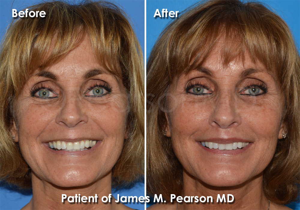 Pearson Plastic Surgery