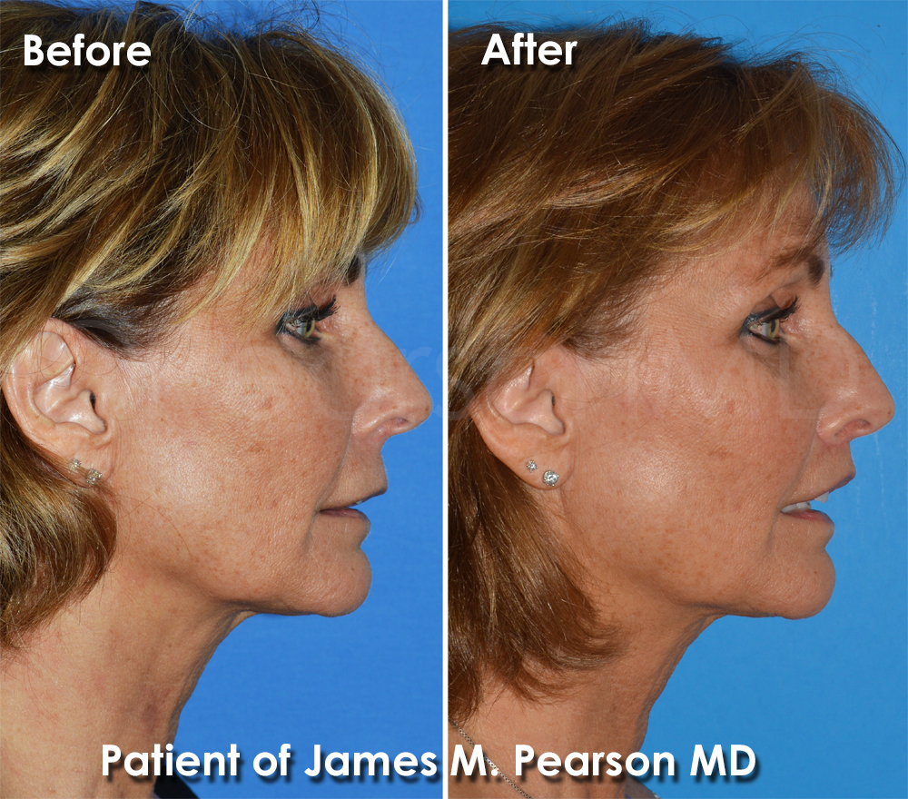 Pearson Plastic Surgery