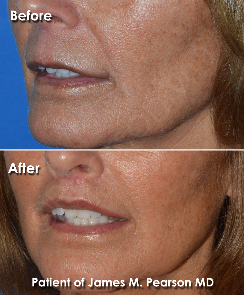 Dr. Pearson Plastic Surgeon