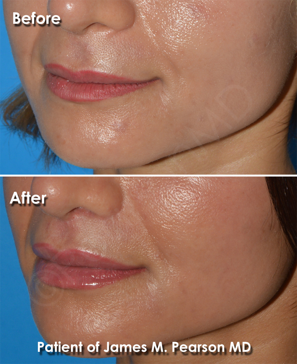Dr. Pearson Plastic Surgeon
