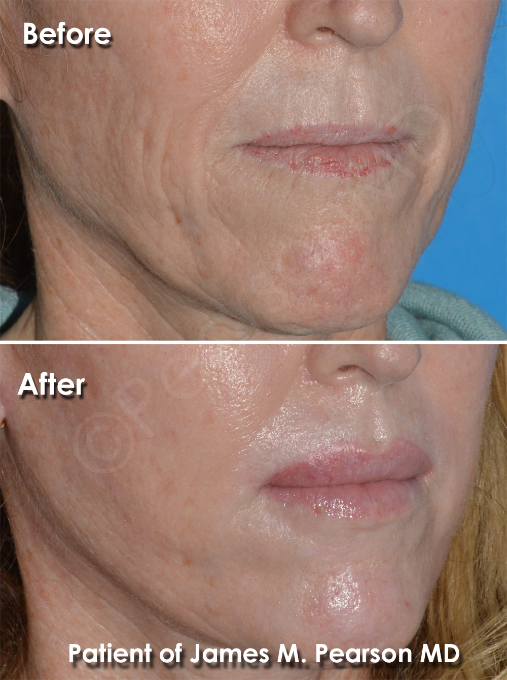 Vermilon Advancement Lip Lift