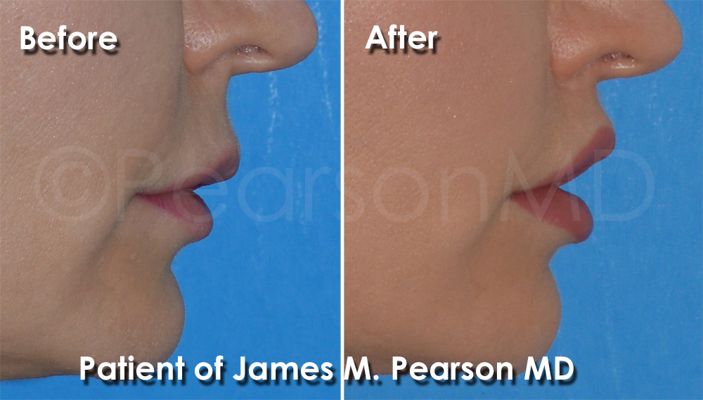 Dr. Pearson Lip Lift Surgery