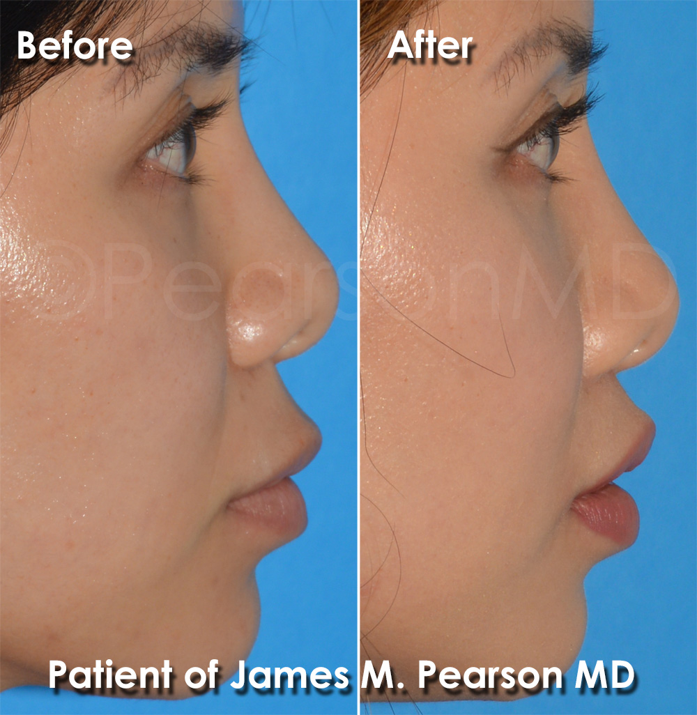 Beverly Hills Lip Lift