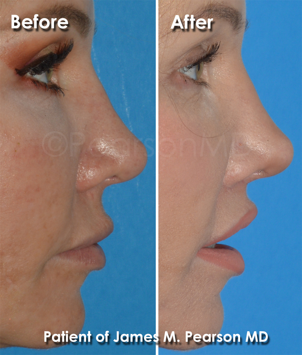 Redondo Beach Plastic Surgery