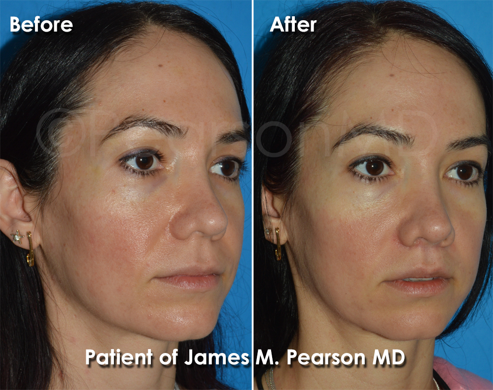 Dr. Pearson Lip Lift Surgery