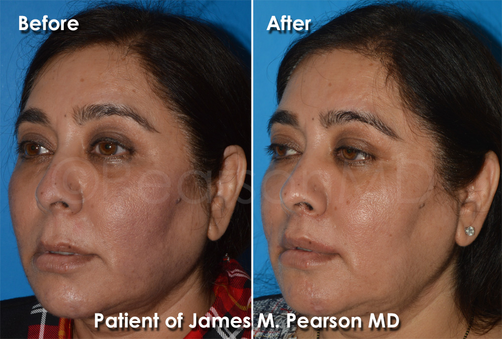 Dr. Pearson Cosmetic Surgery