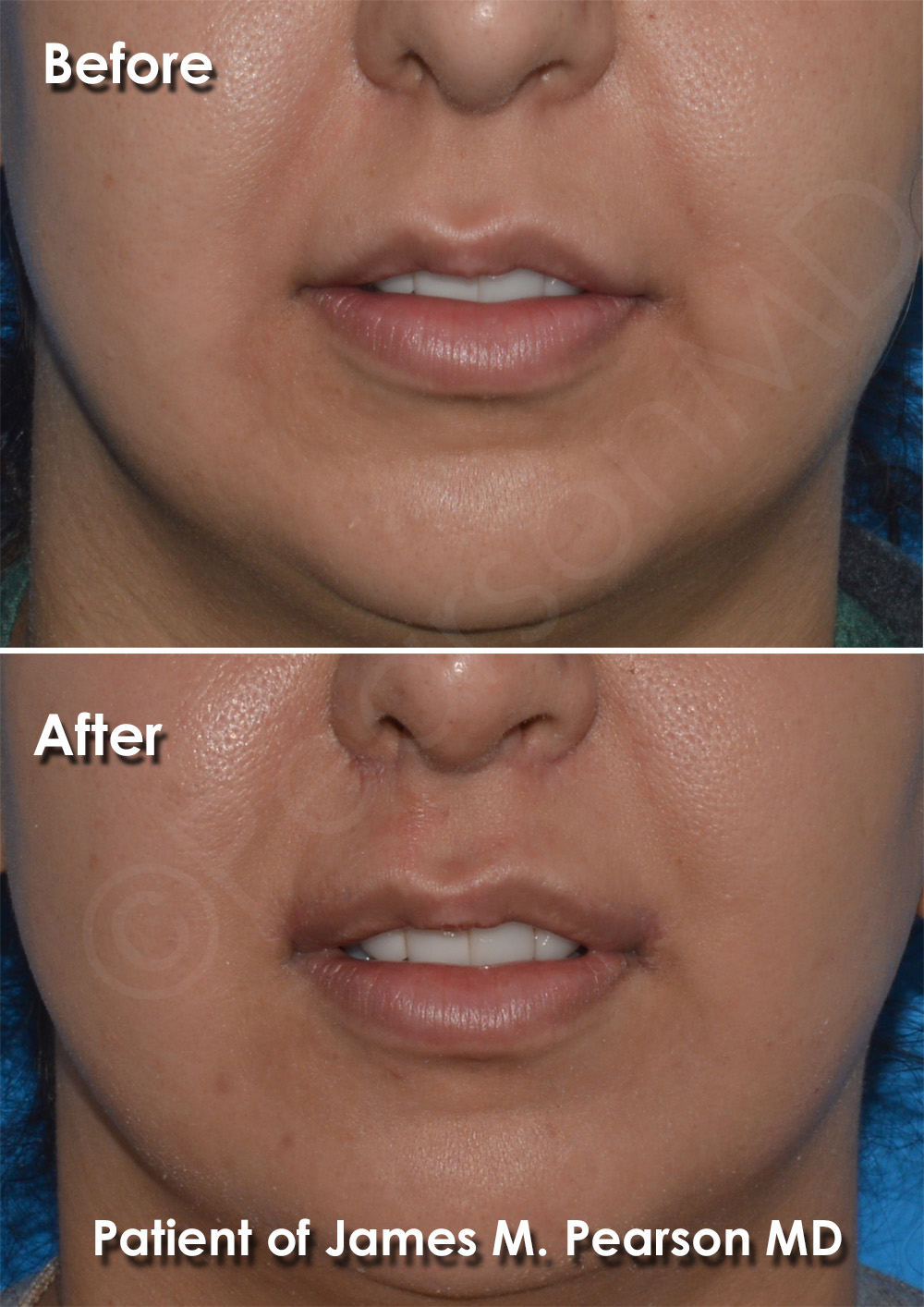Dr. Pearson Plastic Surgeon