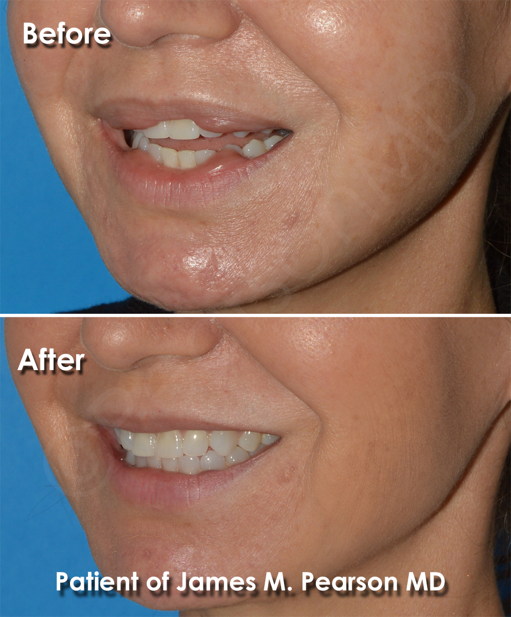 Lip Reduction